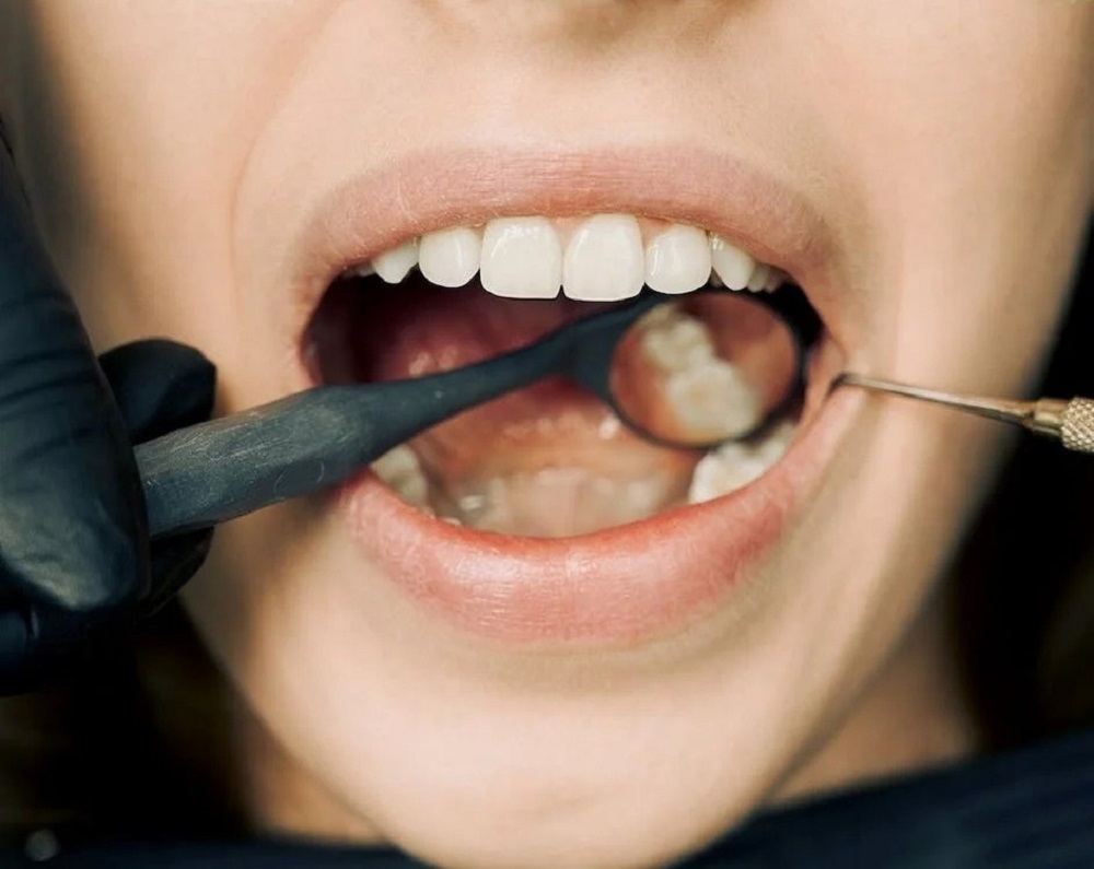 5 Bahan Alami yang Ampuh Obati Sakit Gigi, Gampang Ditemukan dan Simak Cara Pengobatannya di Sini