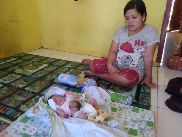 Derita Omphalocele, Bayi 3 Minggu Butuh Bantuan