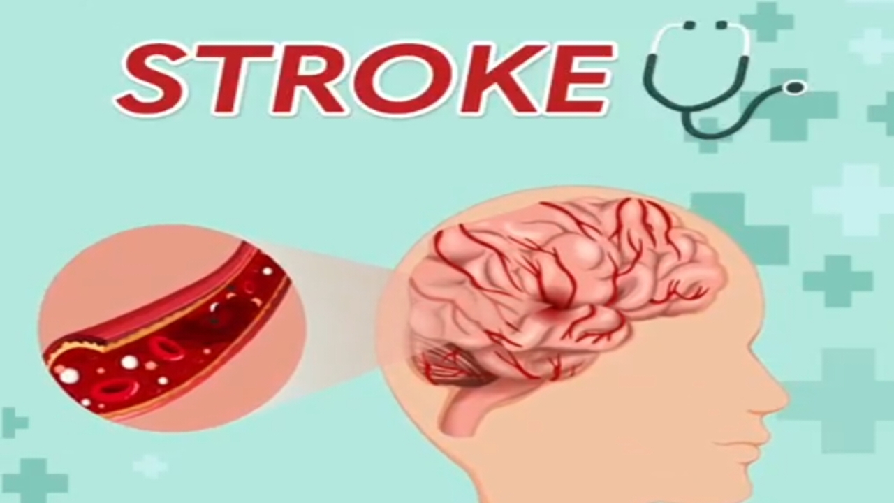 Cara Deteksi Dini Serangan Stroke dan Langkah-langkah Penanganannya