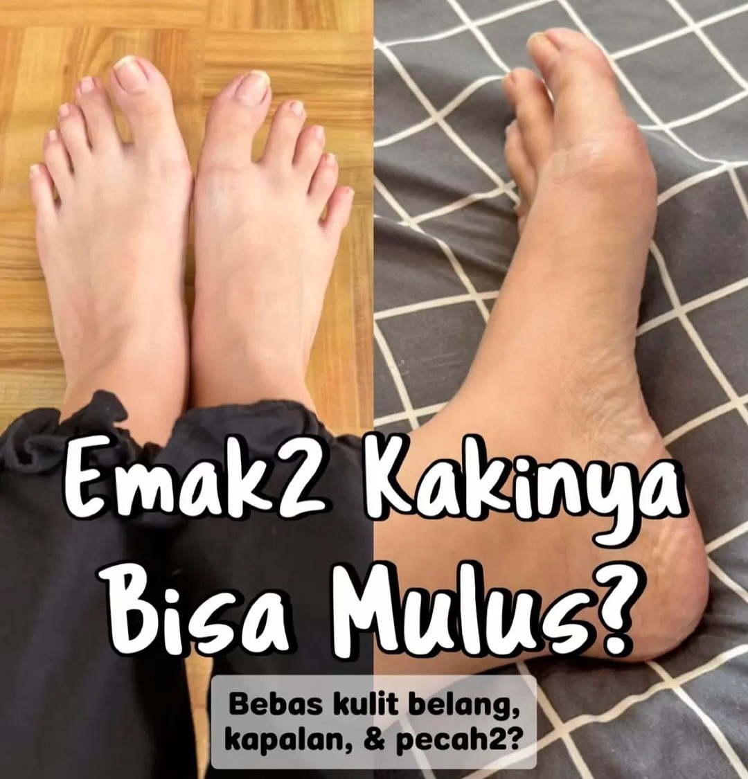 4 Produk Terbaik untuk Menjaga Kesehatan Kulit Kaki, Termasuk Tumit Anda!