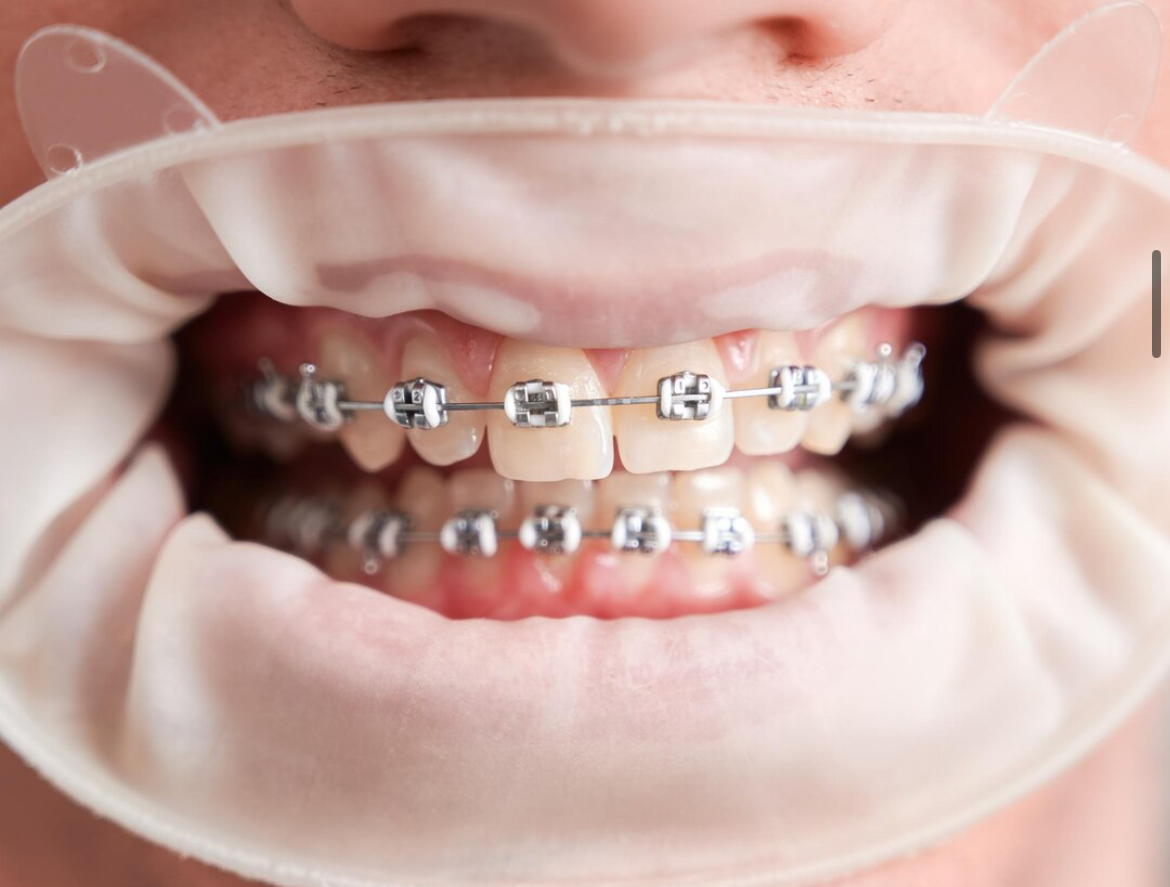 Pengalaman Gigi Berbehel Pasca Pemasangan dan Tips Menghadapi Rasa Sakitnya