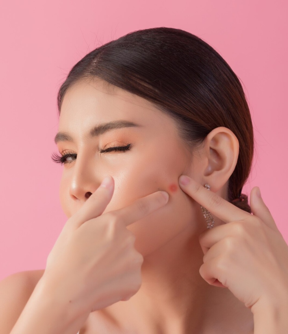 Kulit Berjerawat Pasca-Lebaran? Cari Tahu Cara Ampuh Mengatasinya di Sini!