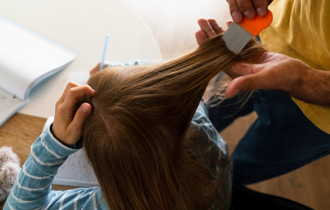 Jangan Anggap Sepele! Kutu Rambut Bisa Picu Penyakit Ini pada Anak, Ini Cara Pencegahannya