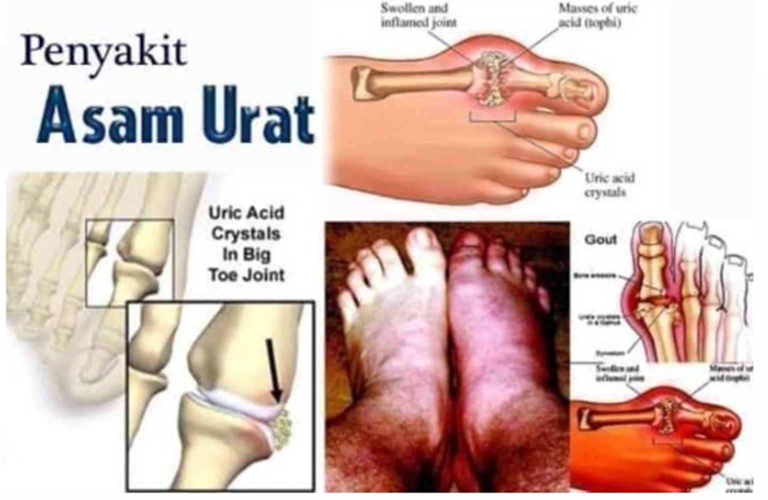 Sering Nyeri Sendi, Awas Gejala Asam Urat, Segera Cek Darah dan Minta Saran Dokter 