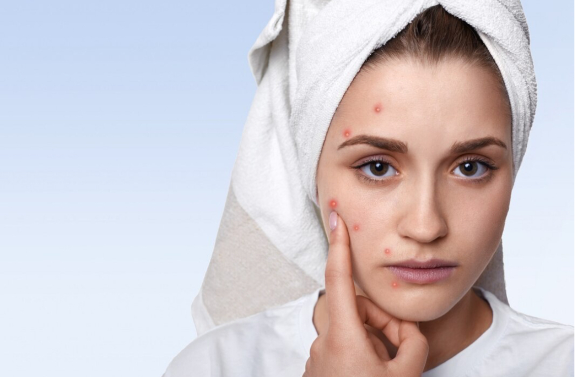 Tips Ampuh Tanpa Efek Samping! Ini 10 Rahasia Skincare Alami untuk Mengatasi Jerawat 
