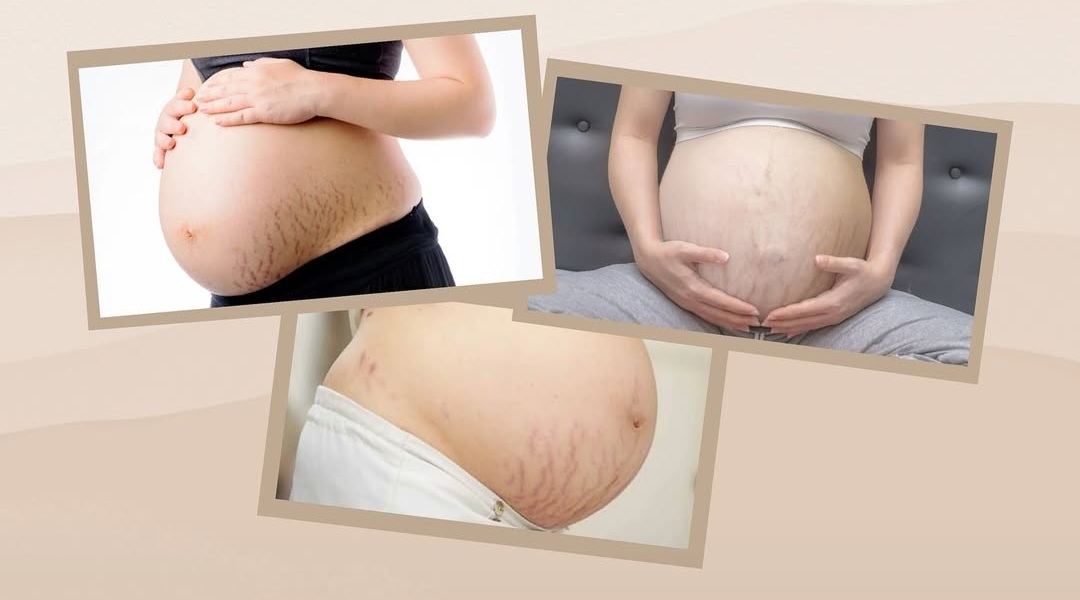 Muncul Garis di Kulit Saat Hamil? Kenali Penyebab Stretch Mark pada Ibu Hamil Sebelum Terlambat!