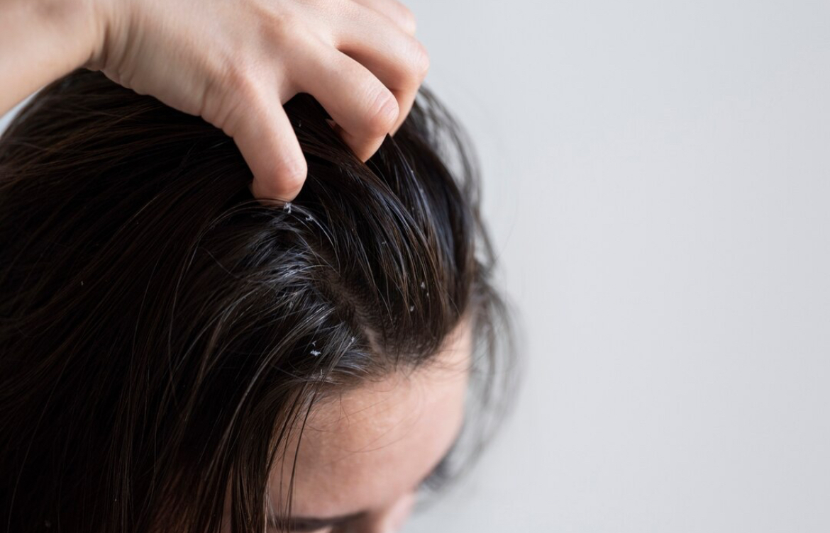 Kulit Kepala Sehat, Rambut Kuat: Pengaruh Diet Pada Kesehatan Rambut