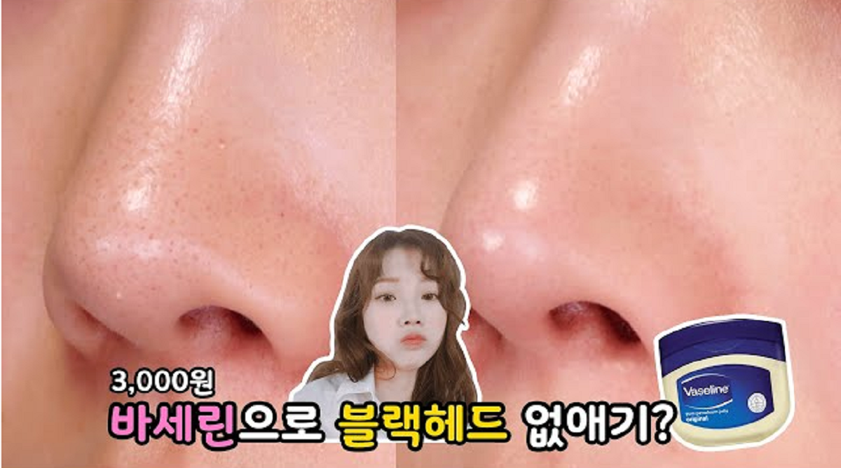 Benarkah Vaseline Bisa Membersihkan Komedo? Simak di Sini Fakta dan Caranya