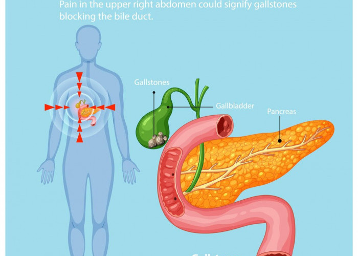 Ini Tanda-tanda Kamu Menderita Penyakit Batu Empedu, Ketahui Cara Pencegahan dan Mengatasinya