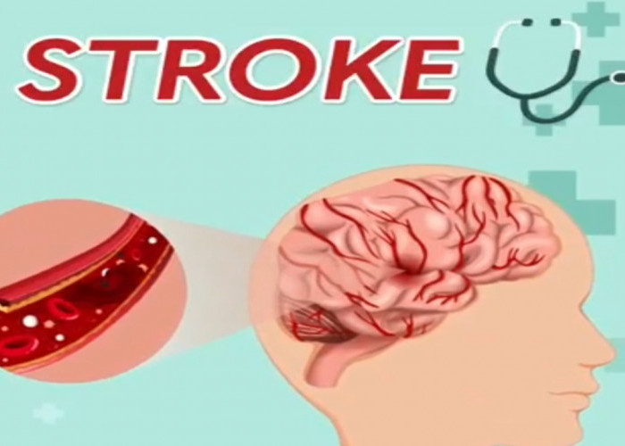 Cara Deteksi Dini Serangan Stroke dan Langkah-langkah Penanganannya