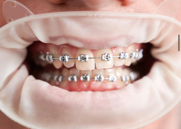 Pengalaman Gigi Berbehel Pasca Pemasangan dan Tips Menghadapi Rasa Sakitnya