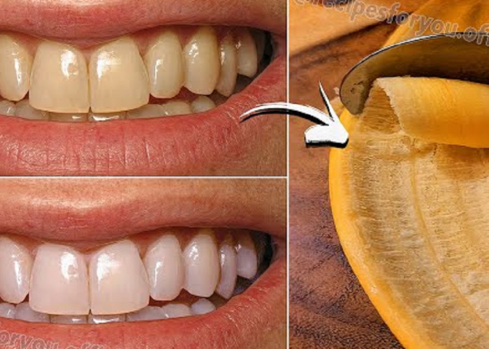 Benarkah Kulit Pisang Bisa Memutihkan Gigi? Simak Fakta, Cara, dan Manfaatnya di Sini