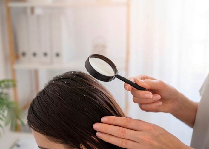 Cara Mengatasi Ketombe Secara Alami: Tips Ampuh untuk Rambut Bebas Ketombe