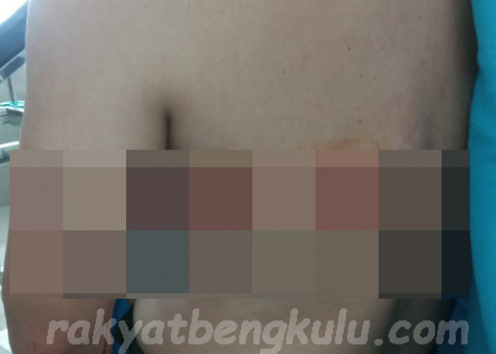 Lihat! Luka Diduga Bekas Tembak di Tubuh Calon DPD Bengkulu Rahiman Dani, Ngeri 