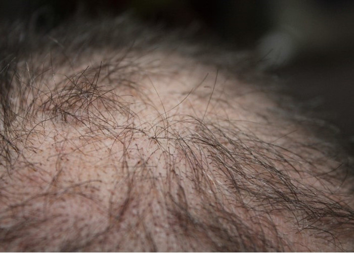 Rambut Adalah Mahkota Kepala, 5 Ciri-ciri Rambut Rusak yang Harus Diwaspadai dan Banyak Orang Tidak Sadar