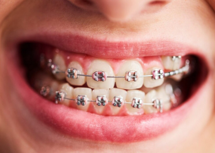 Tips Perawatan Gigi yang Berbehel: Ini Perlengkapan Pembersih Penting yang Harus Kamu Siapkan