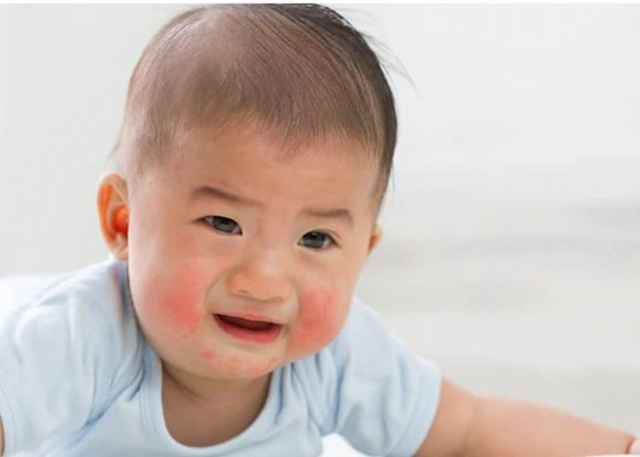 Hati-hati! Bayi Bisa Alergi Makanan, Menangis Terus Menerus, Muncul Biduran